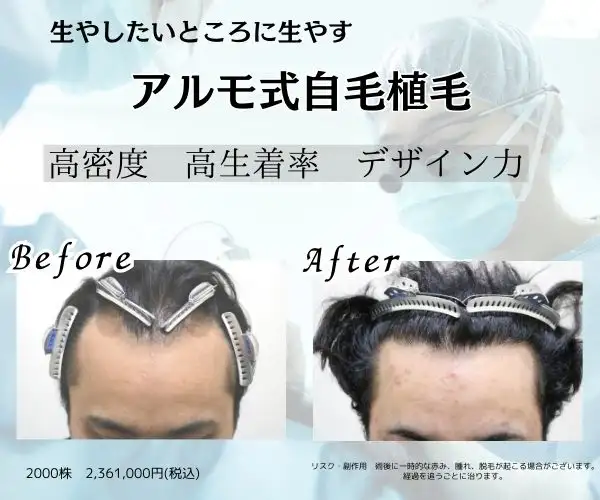 成約率７割超、自毛植毛クリニックをご紹介ください。【アルモ形成クリニック】